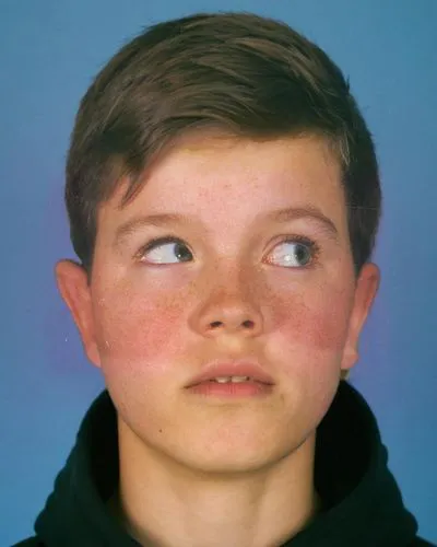 A 15-year-old boy with a Left Brown's syndrome. He is trying to look upwards to his right. He has a very slight elevation of his chin. He has a slightly concerned look on his face. The Boy is the only