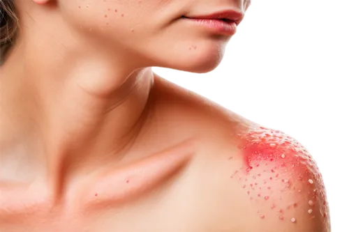 keratosis,scuticaria,pityriasis,folliculitis,papules,rosacea,dermatitis,psoriasis,epidermal,dermatologic,lymphadenitis,erythema,urticaria,melanomas,epidermis,keratoses,inflammations,eczema,dermatosis,cutaneous,Illustration,Realistic Fantasy,Realistic Fantasy 18