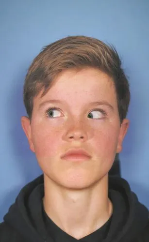 A 15-year-old boy with a left Brown’s syndrome. He is being photographed as part of a routine eye exam and is photographed in front of a plain blue background. He is trying to look directly towards hi