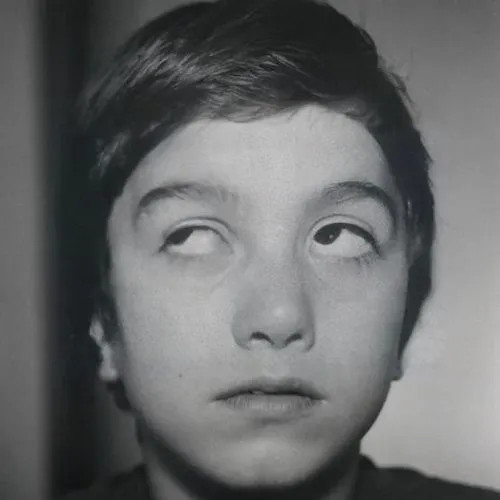 A black and white photograph of a young boy, probably about 9 years old or so, with a misalignment of his left eye. He is trying to look upward and to his left, but his left eye appears over elevate a