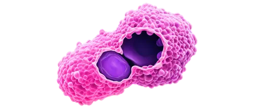 Cancer cell, stomach, microscope view, irregular shape, purple nucleus, pink cytoplasm, 3D illustration, high-contrast lighting, dark background, close-up composition, medical concept art.,splenomegal