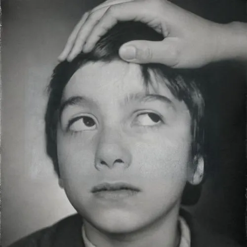 A black and white photograph of a young boy, probably about 9 years old or so, with a misalignment of his left eye. He is trying to look upwards and towards his right but his left eye doesn’t appear t