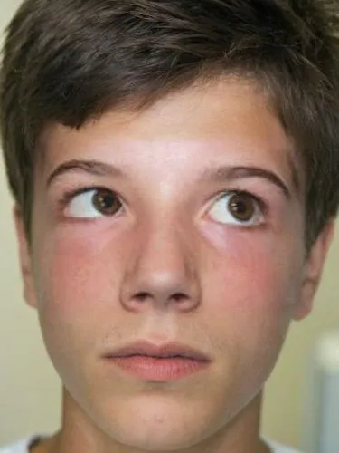 An up close photo of a teenage boy, perhaps about 14 or 15 years old with brown eyes and short, dark brown hair. He is seated at the eye doctor’s office with his chin slightly raised. He is wearing a 