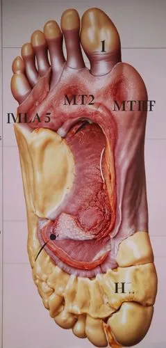 I took this picture from the research paper. I need the same picture but a little bit changed . In this picture a human foot is shown with ulcer. ,reflex foot esophagus,reflex foot kidney,laryngectomy