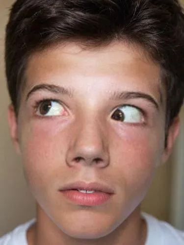 An up close photo of a teenage boy, perhaps about 14 or 15 years old with brown eyes and short, dark brown hair. He is seated at the eye doctor’s office with his chin slightly raised. He is wearing a 