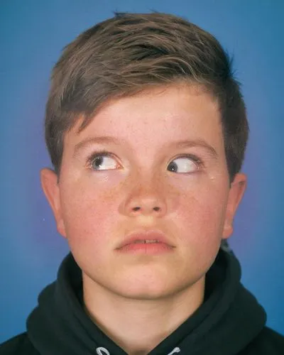 A 15-year-old boy with a Left Brown's syndrome. He is trying to look upwards to his left. His left eye will not elevate normally. He has a very slight elevation of his chin. He has a worried look on h